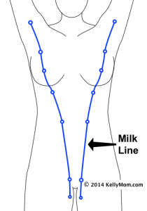 Extra (supernumerary or accessory) nipples or breast tissue